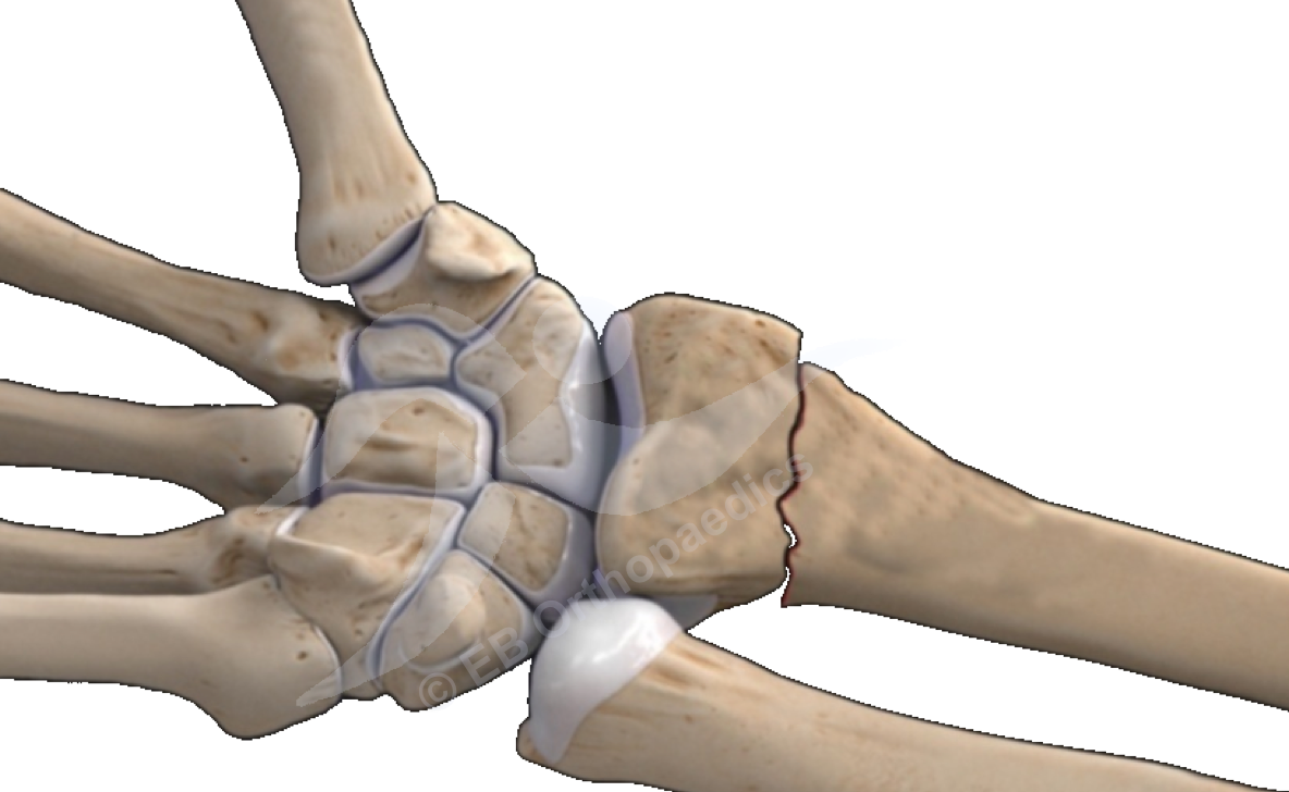 Wrist fractures